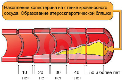 Триглицериды - что за звери и стоит ли их бояться? Триглицериды - что за звери и стоит ли их бояться?